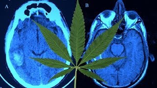 Does Smoking Weed Restructure Your Brain?